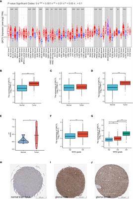 Deciphering the role of QPCTL in glioma progression and cancer immunotherapy